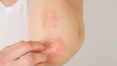 Psoriasis: características y recomendaciones para su manejo – Adeslas Salud y Bienestar