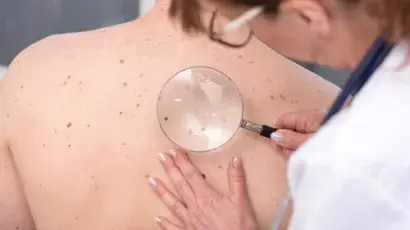 nevus.jpg