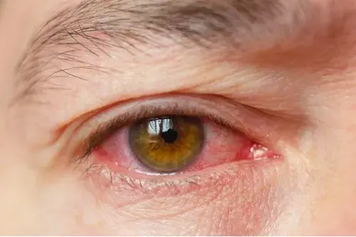 ¿Ojos rojos? Puede que tengas conjuntivitis