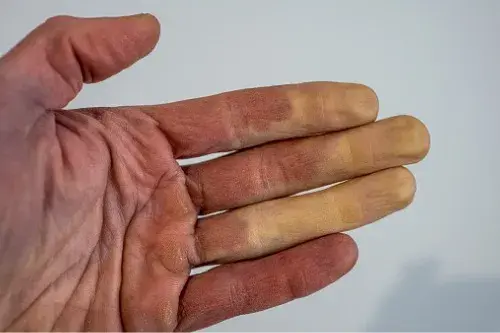 Síndrome de Raynaud: qué es y por qué se produce