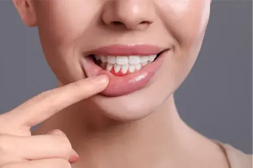 Periodontitis: què és i per què es produeix