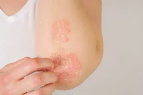 Psoriasis: características y recomendaciones para su manejo