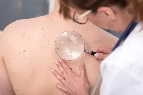 Nevus: un lunar con características peculiares